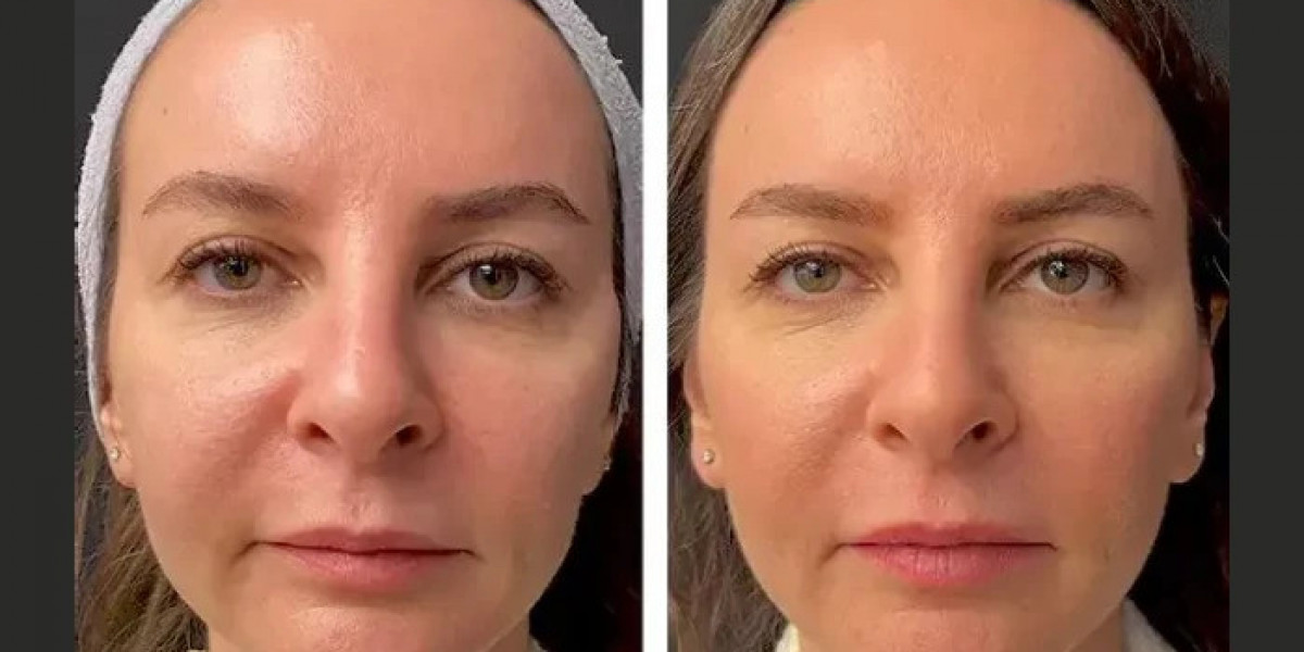 Mesotherapy Treatment in Dubai: Myths vs. Facts