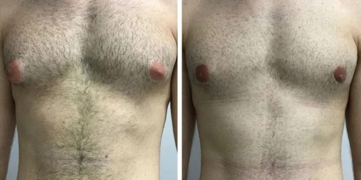 The Best Gynecomastia Surgeons in Dubai: Minimally Invasive Options